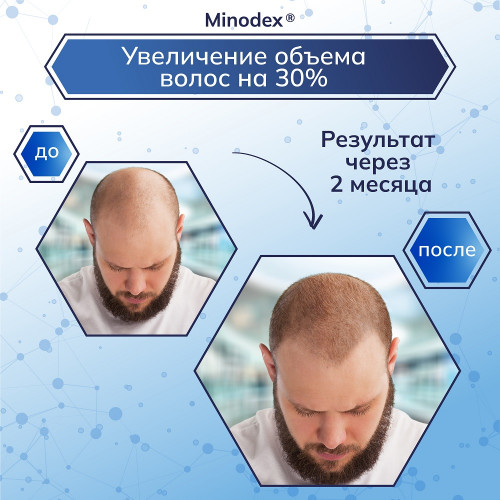 Лосьон с миноксидилом Minodex 15%, 6 флаконов и мезороллер